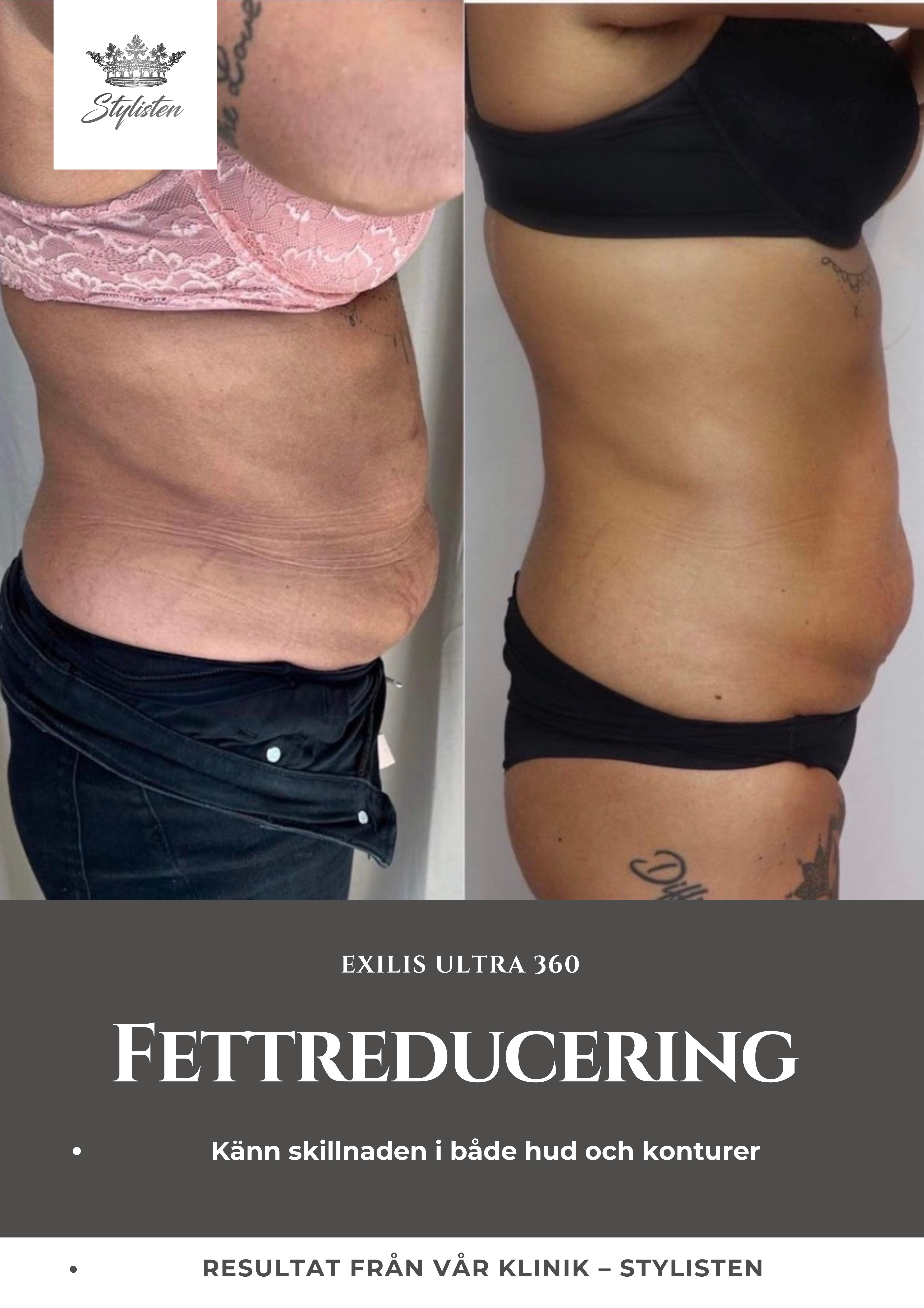 Exilis Ultra 360 fettreducering resultat hos Stylisten Västerås