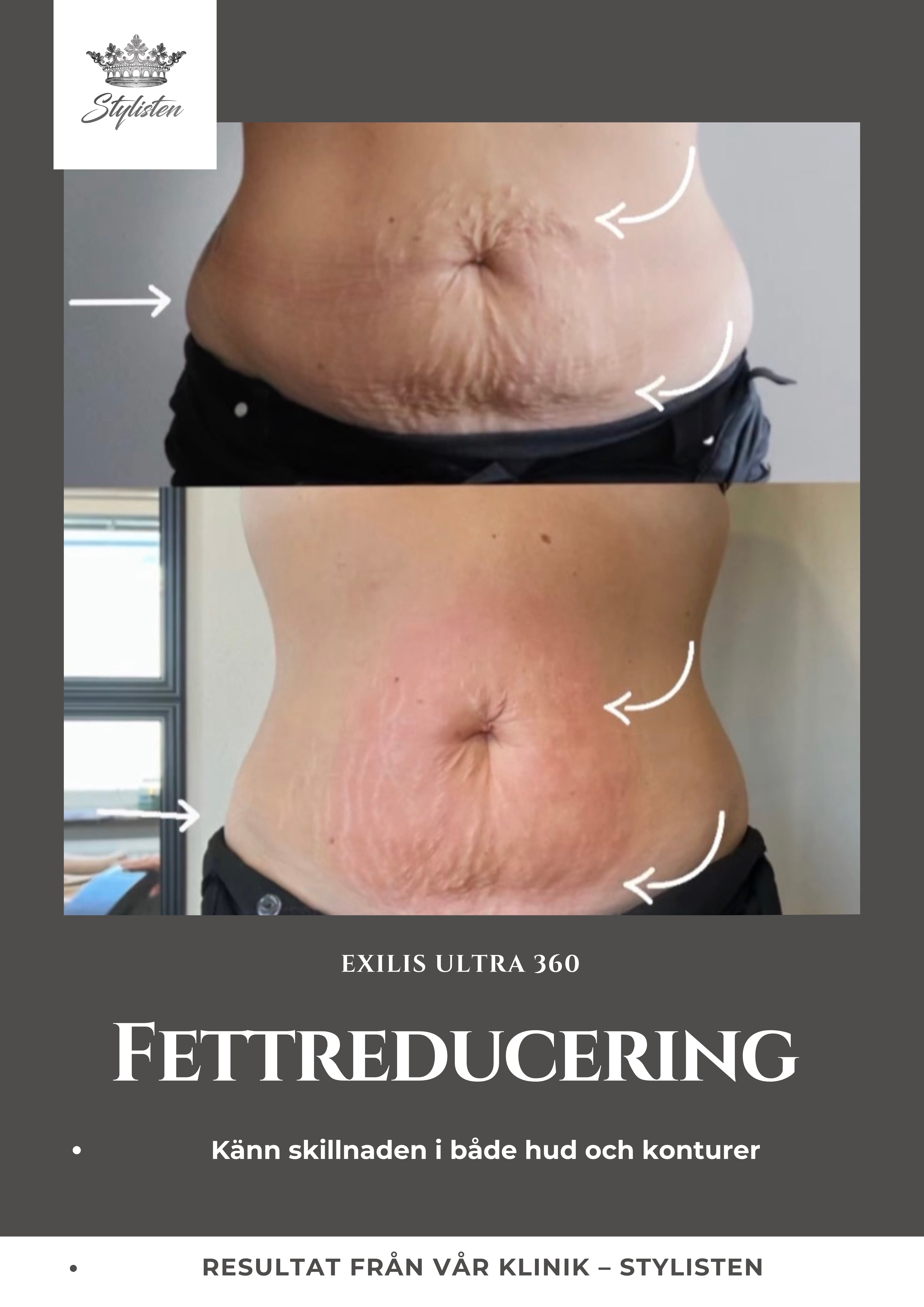 Exilis Ultra 360 mage före och efter hos Stylisten