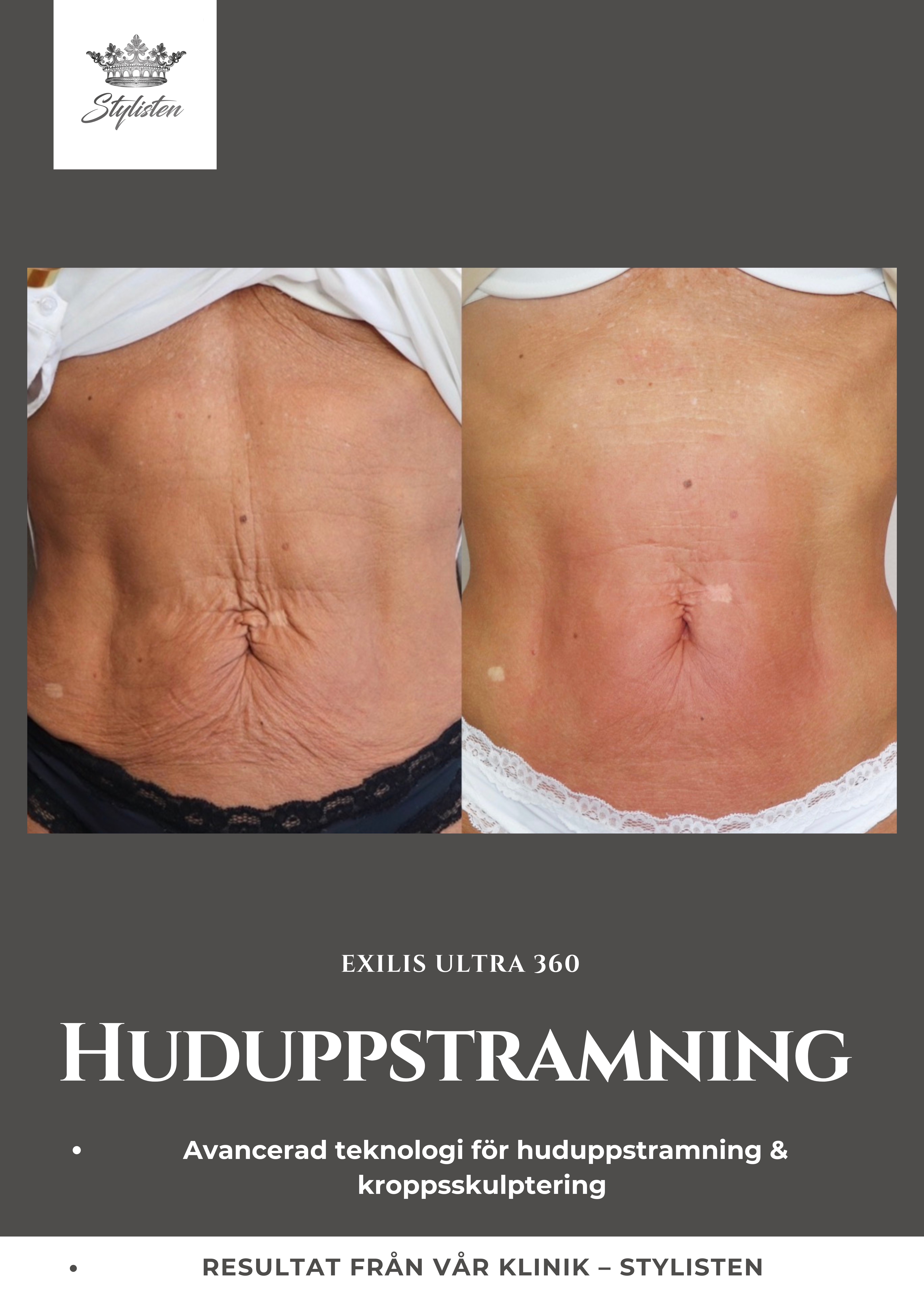 Exilis Ultra 360 huduppstramning resultat hos Stylisten