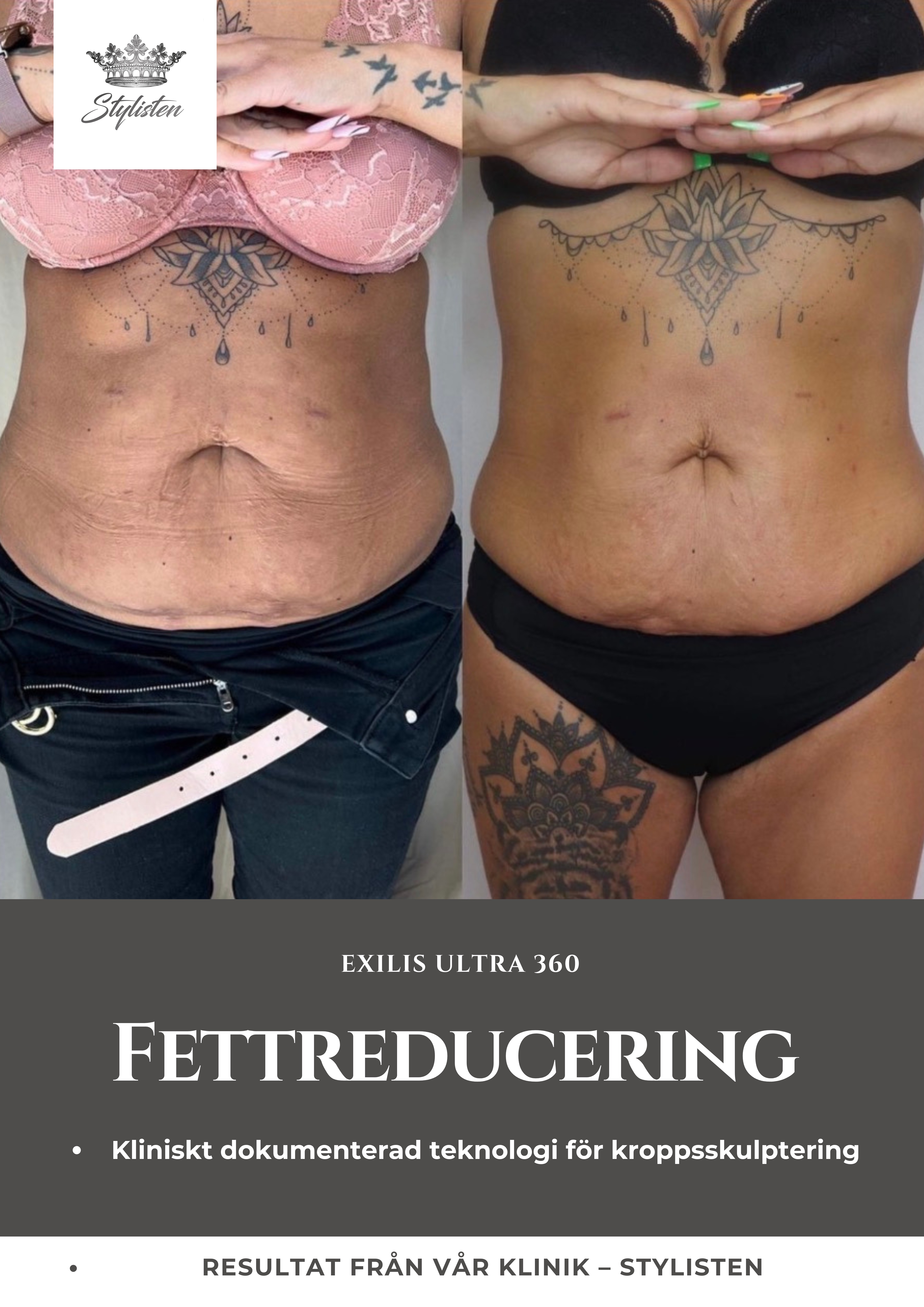 Exilis Ultra 360 fettreducering mage före och efter Stylisten